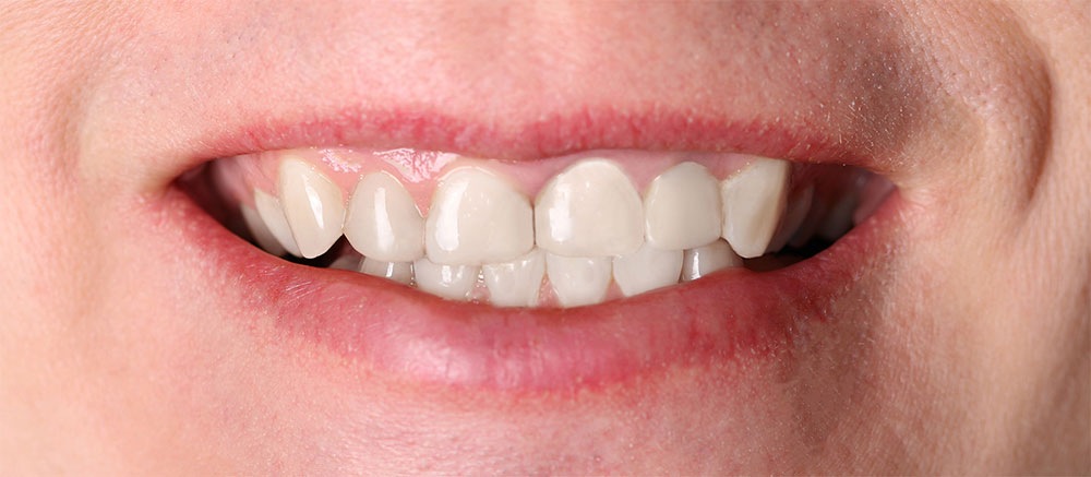Zahnersatz Mühltal nachher Zahnarzt Dr. Büchl