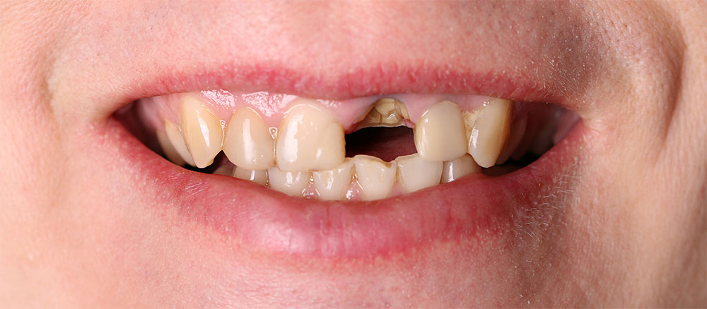 Zahnersatz Mühltal vorher Zahnarzt Dr. Büchl